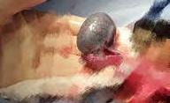 chau be bi cat tinh hoan vi nhap vien muon hinh 1