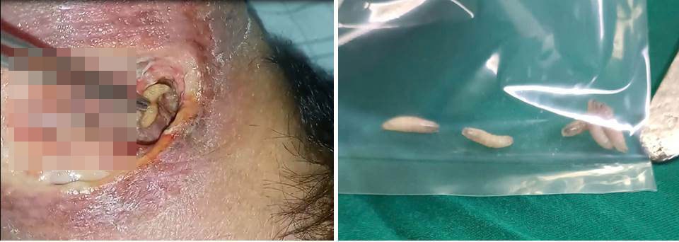 Rùng mình giòi bò lổn nhổn trong vết thương bị hoại tử của cụ ông 82 tuổi