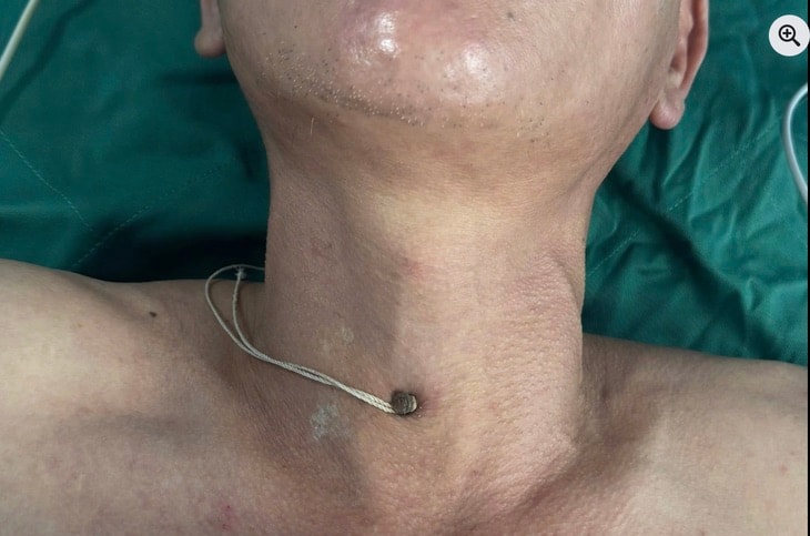 Cấp cứu người đàn ông bị đinh thép cắm sâu vào cổ khi đang thi công công trình