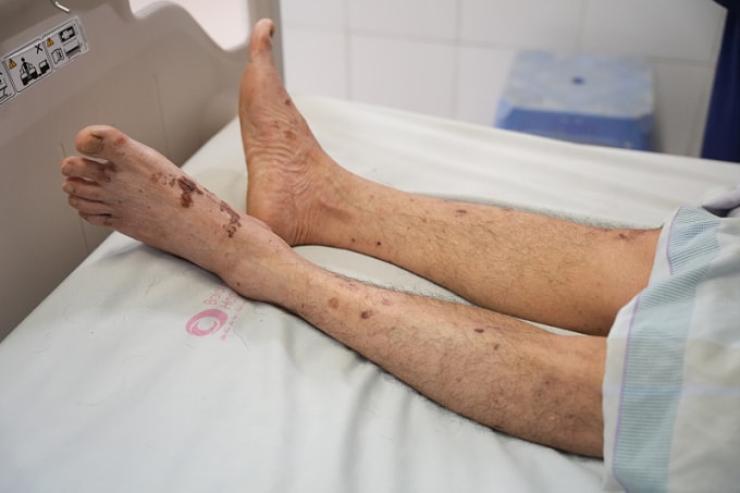 Bệnh nhân điều trị tại viện. Ảnh: Bệnh viện cung cấp