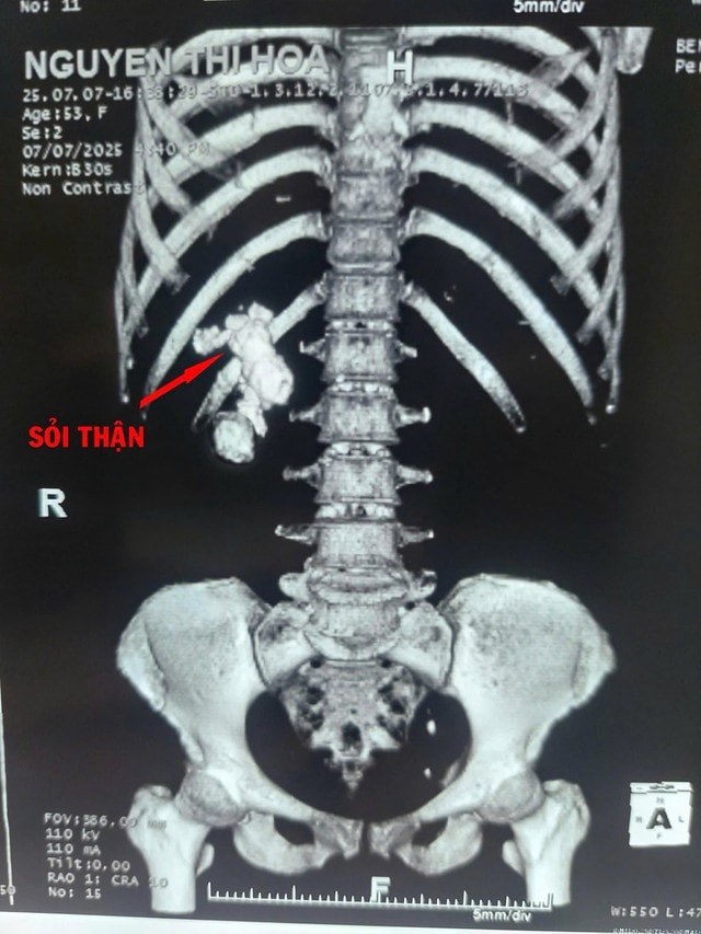 Phẫu thuật thành công ca sỏi thận san hô phức tạp - Ảnh 1.