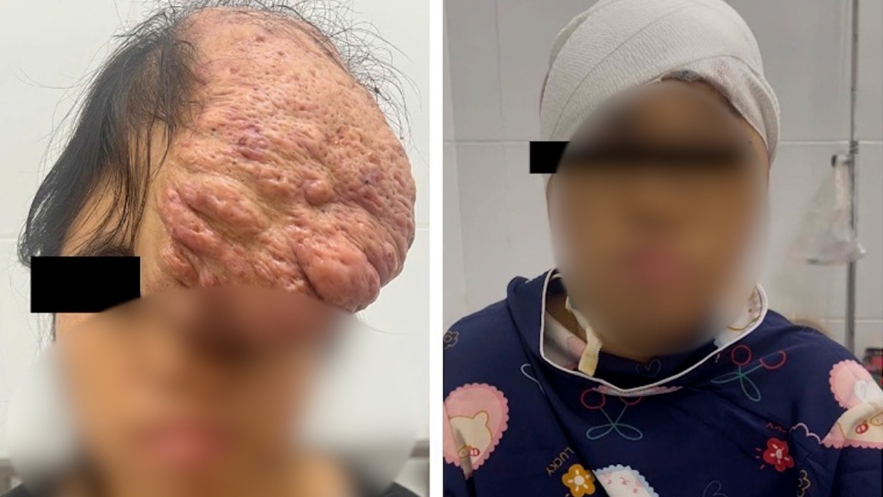 Người phụ nữ mang khối u sụn xương sọ kích thước khổng lồ trên gương mặt