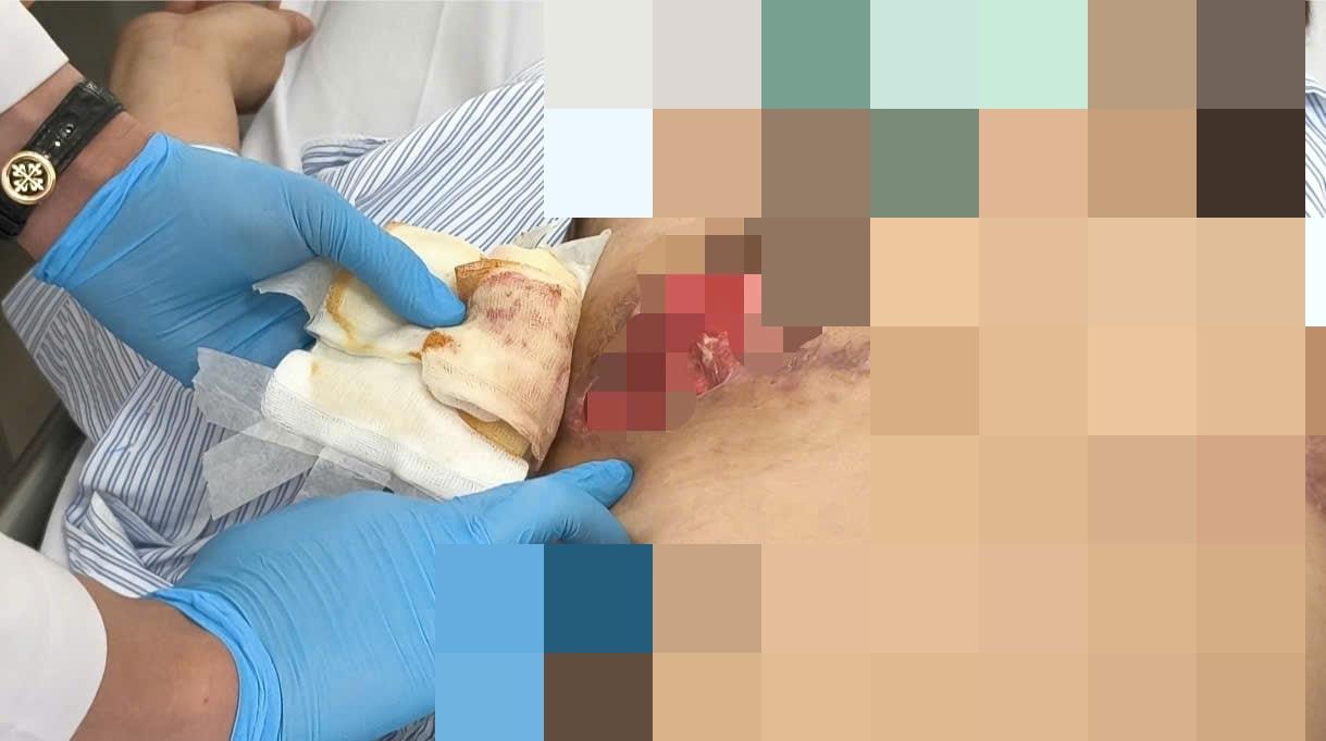 Hoại tử vòng 1, nhiễm trùng nặng sau phẫu thuật thẩm mỹ