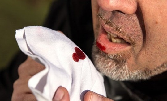 Gia tăng viêm phổi do thuốc lá điện tử ở người trẻ tuổi