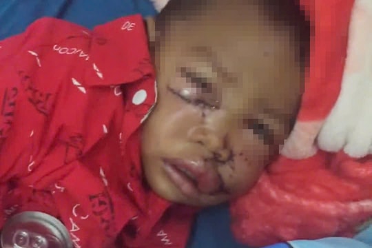 Gia Lai: Đang chơi sau nhà, bé trai 2 tuổi bị chó hoang tấn công