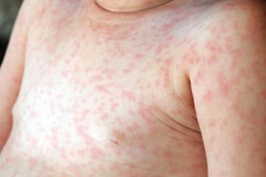 Quảng Nam: Phần lớn các ca mắc sởi chưa được tiêm vắc xin