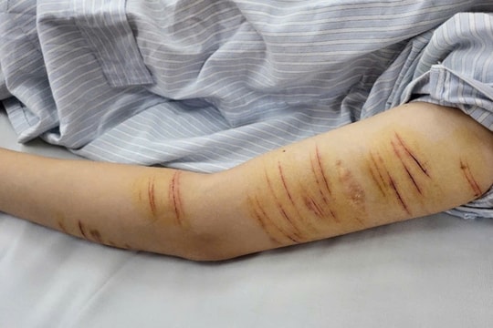 Áp lực học tập, nỗi cô đơn, một học sinh tự rạch sâu vào tay chân mình