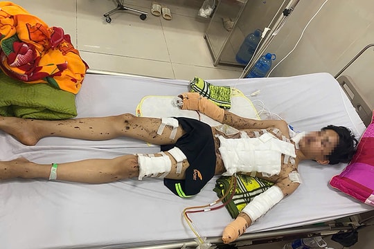 Pháo tự chế phát nổ, nam sinh mất bàn tay và tổn thương nghiêm trọng