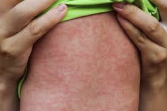 Hà Nội: Ghi nhận một trường hợp tử vong do mắc bệnh sởi