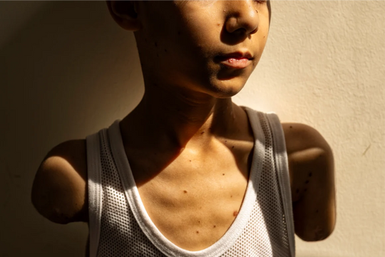 Giải Ảnh Báo chí Thế giới 2025: Vinh danh bức ảnh cậu bé mất cả hai tay ở Gaza