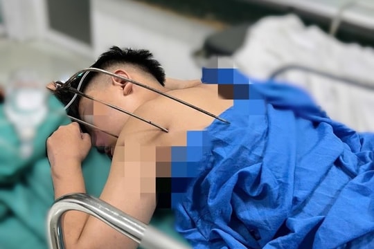 Cứu sống nam thanh niên 17 tuổi bị đinh ba đâm xuyên tim