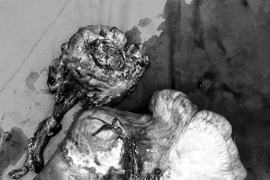 Phẫu thuật thành công khối u ruột non gần 4kg sau 4 năm sống chung với bệnh