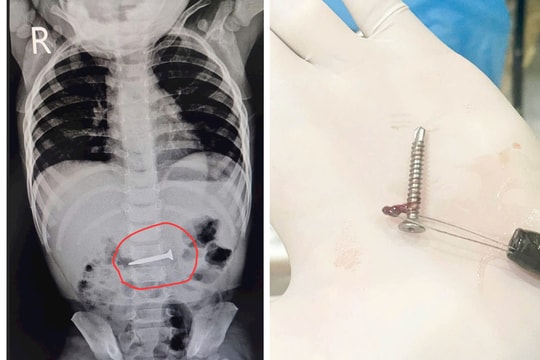 Phú Thọ: Bé gái 19 tháng tuổi thoát nạn sau khi nuốt phải đinh vít dài 2cm