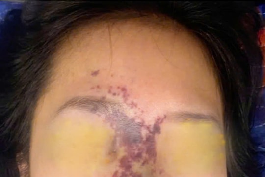 Biến chứng nặng khi làm đẹp tại các cơ sở thẩm mỹ không đảm bảo an toàn