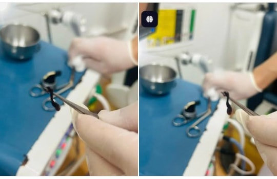 Phát hiện đỉa rừng trong mũi cháu bé hơn 2 tuổi