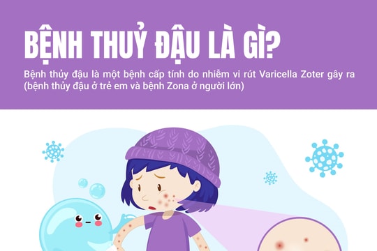 Những điều cần biết về bệnh thủy đậu