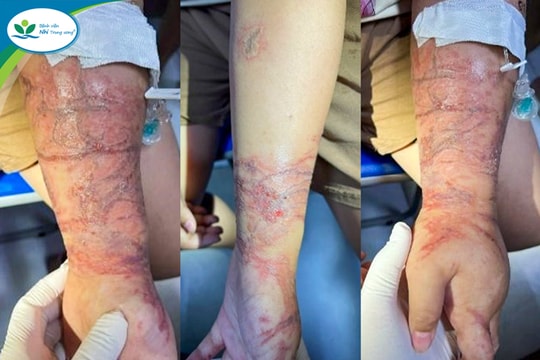 Cảnh báo mùa du lịch biển: Viêm da tiếp xúc do sứa biển