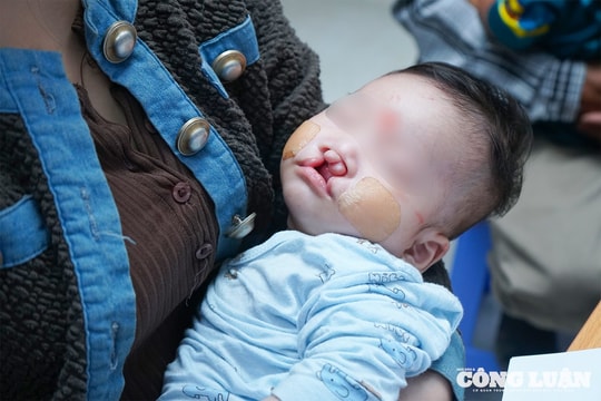 Tìm lại nụ cười cho trẻ em mắc dị tật khe hở môi, vòm miệng