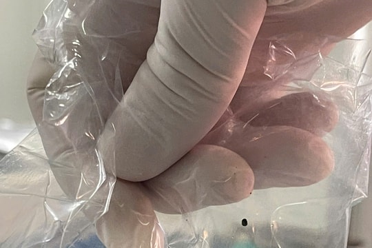 Lấy hàng trăm viên sỏi trong bụng người phụ nữ bị sỏi mật