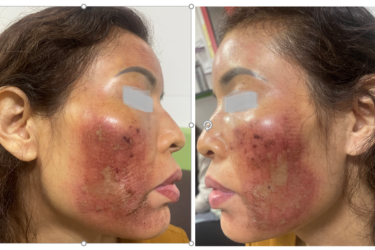 Hàng loạt trường hợp cầu cứu vì peel da không đúng cách