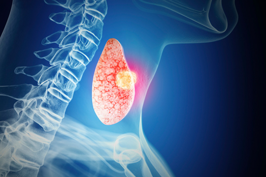 Chuyên gia cảnh báo ung thư tuyến giáp ở người trẻ