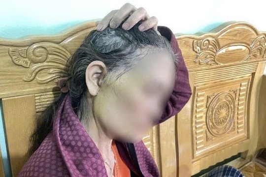 Gia Lai: Nữ bệnh nhân U70 gặp biến chứng sau khi phẫu thuật căng da mặt