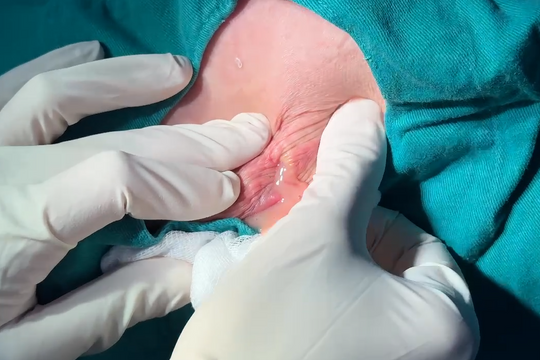 Bị biến chứng sau khi nâng mông độn silicon tại cơ sở thẩm mỹ tư nhân