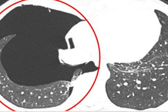 Nam thanh niên tràn khí màng phổi sau khi đẩy tạ quá sức