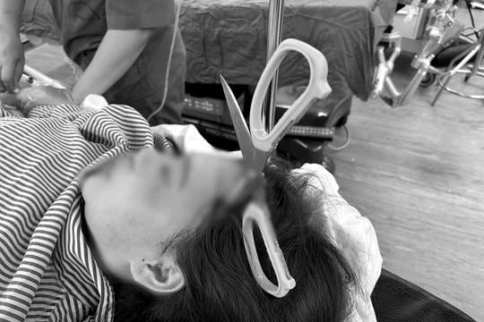 Phẫu thuật cứu sống nữ bệnh nhân bị kéo nhọn đâm xuyên não