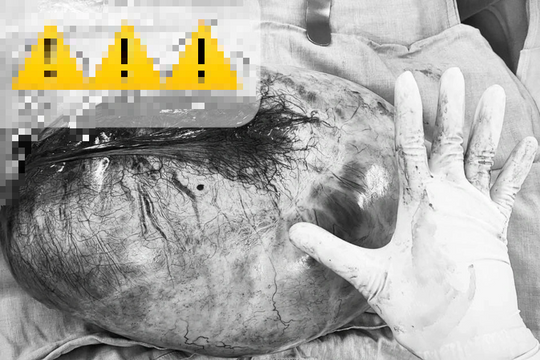 Bóc tách thành công khối u buồng trứng nặng 8kg ở bé gái 13 tuổi