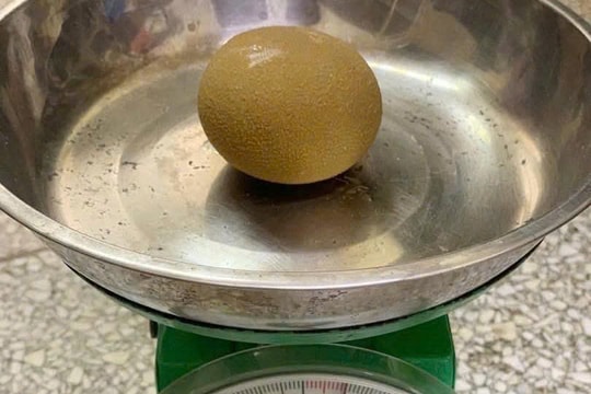 Người đàn ông mang viên sỏi bàng quang bằng quả cam suốt nhiều năm