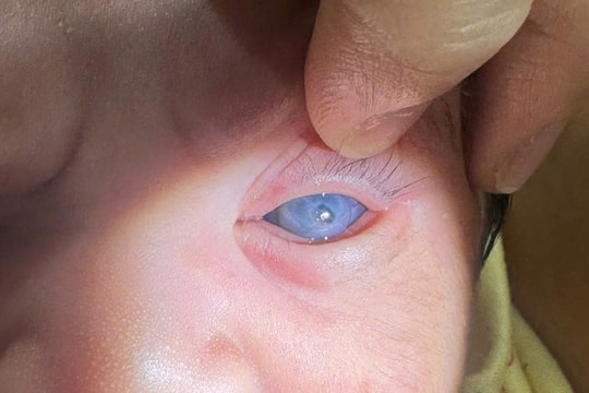 Bệnh glocom ở trẻ em nguy hiểm thế nào?