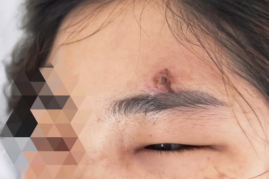 Nữ bệnh nhân tử vong vì nặn mụn tại nhà