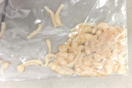 Phát hiện sán dây dài hơn 3 mét vì thói quen ăn rau sống