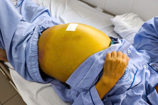 Phát hiện viêm gan B muộn, 2 bệnh nhân gặp bệnh lý nguy hiểm về gan