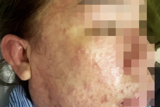 Dùng thuốc giảm mỡ bụng và collagen trôi nổi, người phụ nữ suýt mất mạng