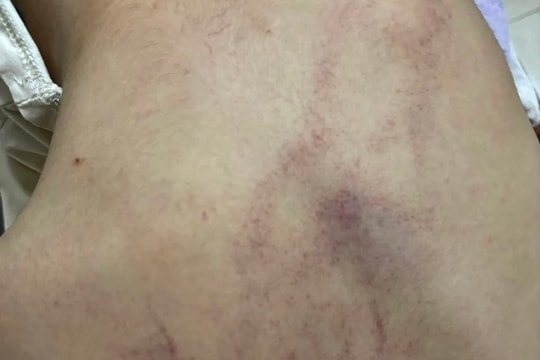 Hà Nội: Khẩn trương làm rõ vụ trẻ mầm non nghi bị bạo hành