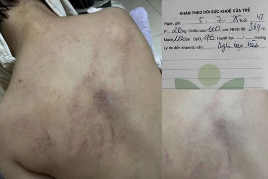 Vụ bé gái 4 tuổi bị đánh tím lưng ở Hà Nội: Đình chỉ thêm một giáo viên, điều tra dấu hiệu bạo hành trẻ