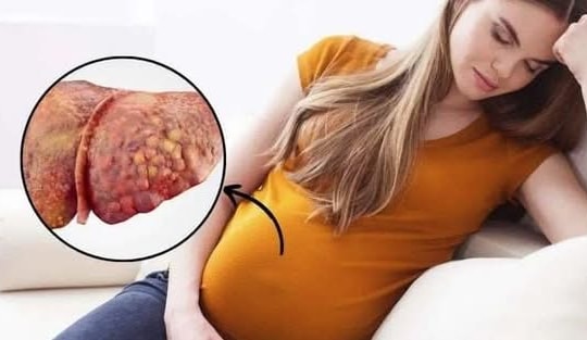 Thoát "cửa tử" sau khi được thay gần như toàn bộ máu: Sản phụ nguy kịch vì gan nhiễm mỡ cấp thai kỳ