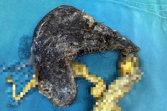 Bé trai 5 tuổi ăn gần nửa cân tóc, bác sĩ sốc khi mở dạ dày lấy búi tóc chiếm gần hết ổ bụng