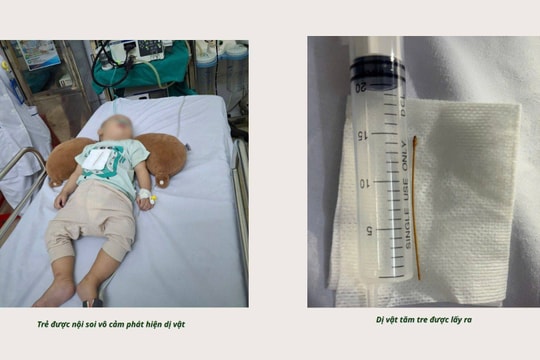 Lào Cai: Kịp thời nội soi gắp tăm tre trong ống tiêu hóa của bệnh nhi 7 tháng tuổi