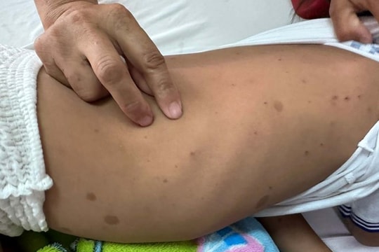 Bé gái 7 tuổi bị ong đốt gần 200 vết, tổn thương giác mạc khi theo bố mẹ lên rẫy