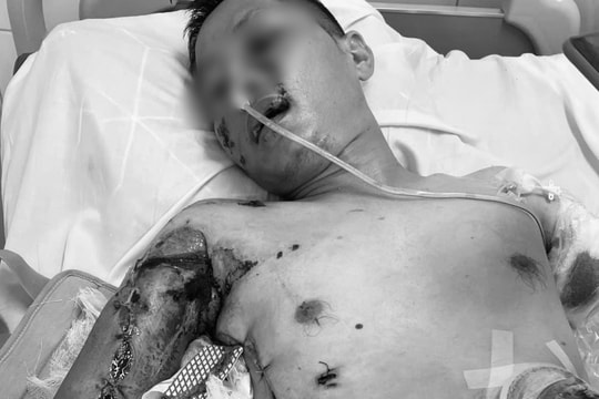 Bác sĩ Việt Đức cứu sống bệnh nhân ngã vào đống sắt toác bụng lộ nội tạng