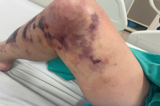 Người phụ nữ sốc nhiễm trùng nguy kịch sau vết trầy nhỏ khi đi bắt ngao