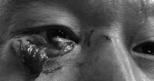 Bị chó cắn rách mi mắt, bệnh nhân được bác sĩ kịp thời phẫu thuật bảo toàn thị lực