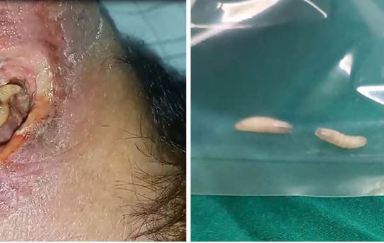 Cảnh báo từ ca bệnh cổ hoại tử trầm trọng