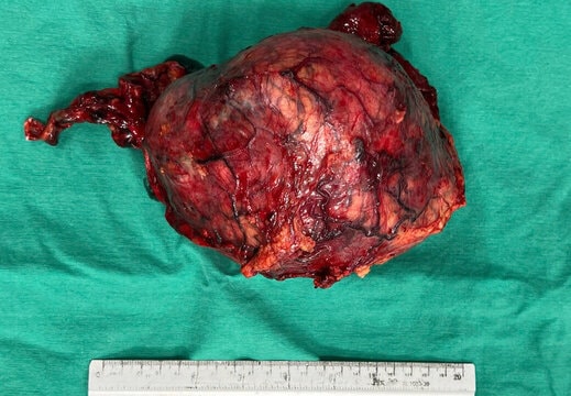 Phẫu thuật thành công khối u thận khổng lồ xâm lấn tĩnh mạch chủ dưới