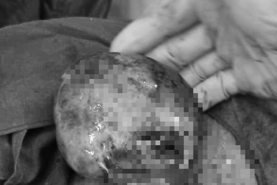 Cháu bé chào đời cùng lúc mẹ được cắt bỏ khối u nang xoắn hoại tử