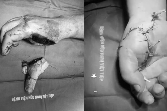 Các bác sĩ kịp thời nối vi phẫu cho cán bộ công an bị chém đứt bàn tay khi làm nhiệm vụ