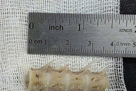 Xương cá dài 4cm găm chặt cổ họng cụ ông 99 tuổi